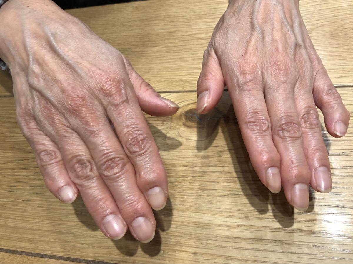 ヘバーデン結節：指先の痛みと変形を正しく理解し、前向きに付き合うための完全ガイド